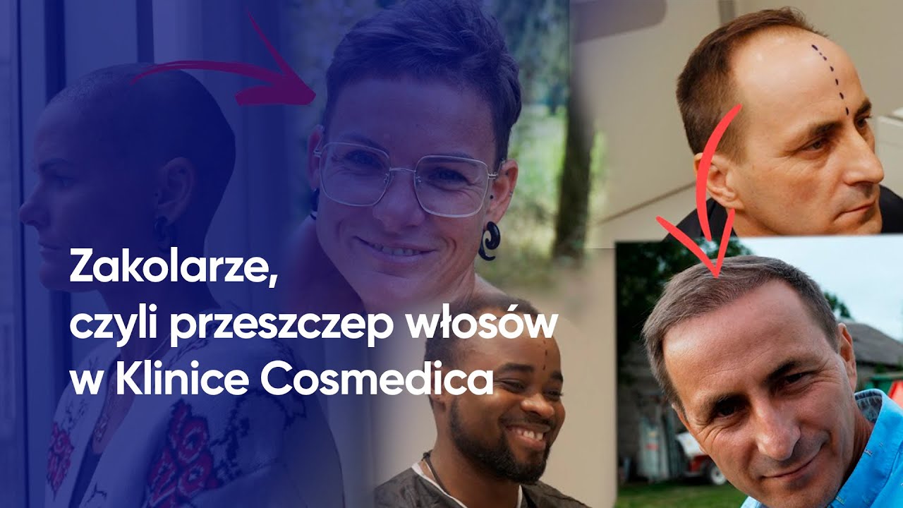 Przeszczep włosów w Turcji - projekt Zakolarze | Cosmedica Clinic Dr. Acar