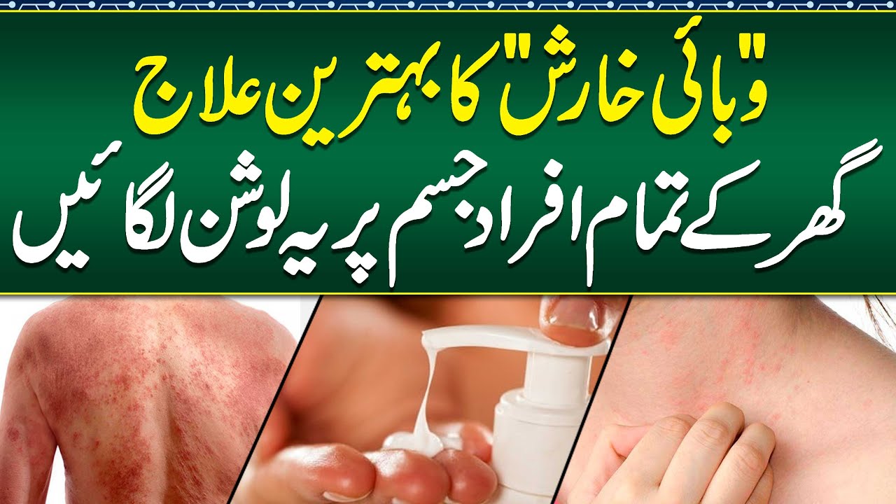 Kharish Ka ilaj- Kharish Khatam Karne Ka Tarika - Scabies Home Treatment - Scabies Causes & Symptoms