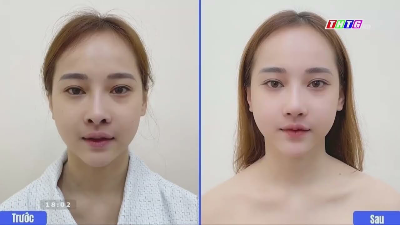 Tại Sao Đắp Khuyết Cánh Mũi Đang Là Hot Trends Làm Đẹp Hiện Nay