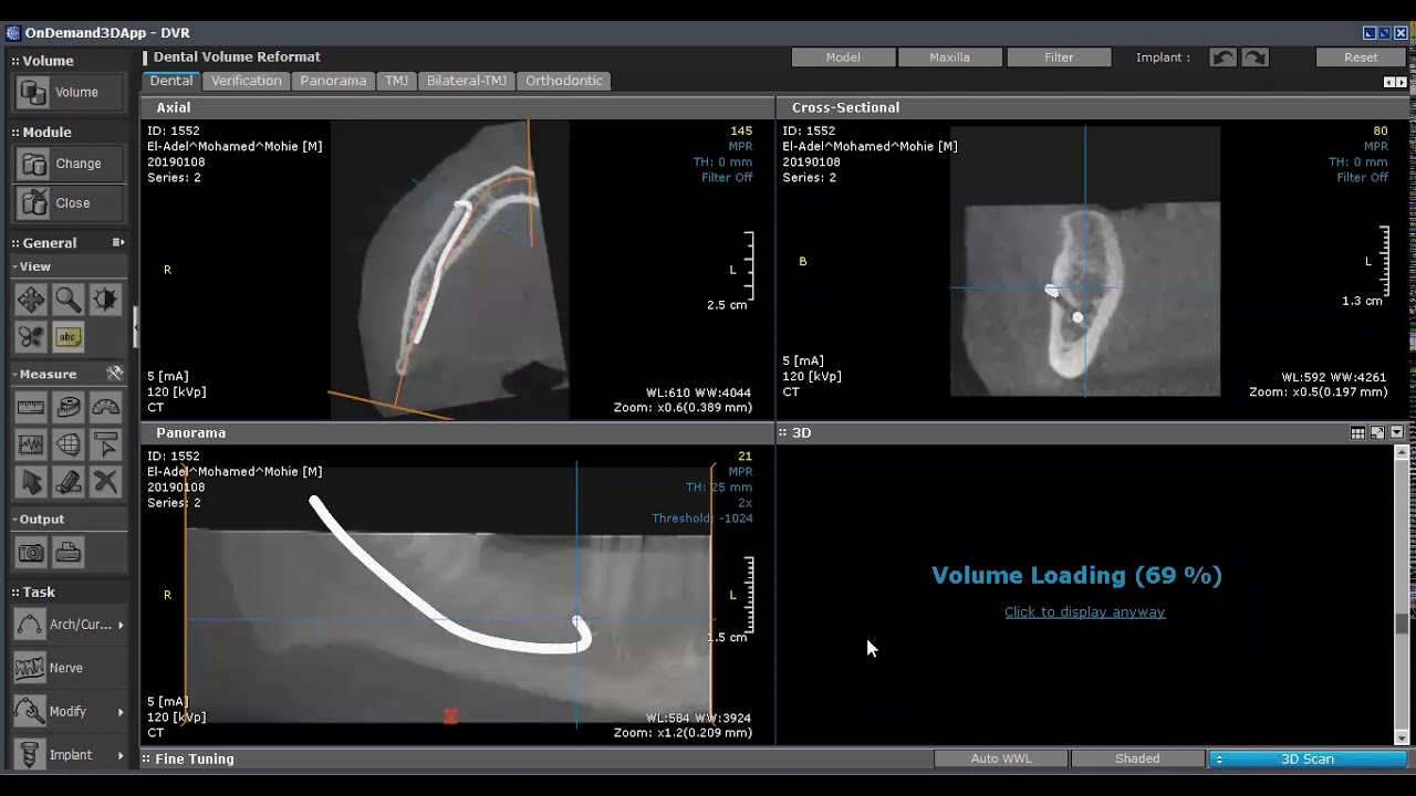 CBCT planning for implant part 1