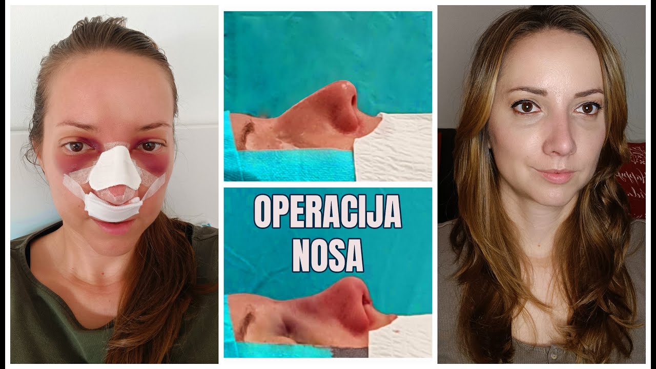 Estetska Operacija nosa - moja iskustva