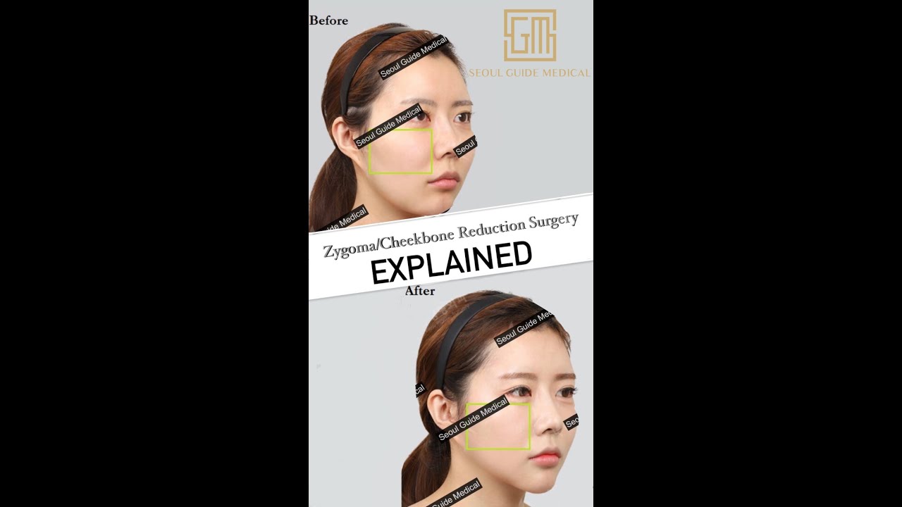 Zygoma/Cheekbone Reduction Surgery | Seoul Guide Medical 