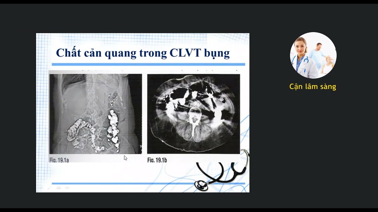 Kỹ thuật chụp Cắt lớp vi tính Bụng