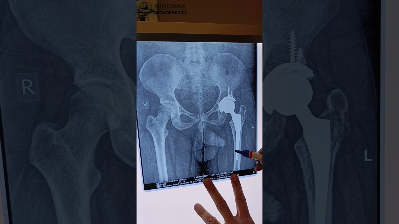 Hip Replacement for Fracture Non union
