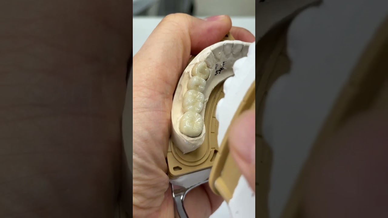 Old dental lab technique but still best!