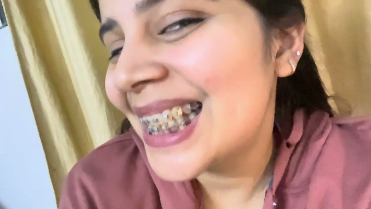 Mere braces ke wire nikal gye 🥲#trending #youtube #teeth #dentalcare #viral #dentist 