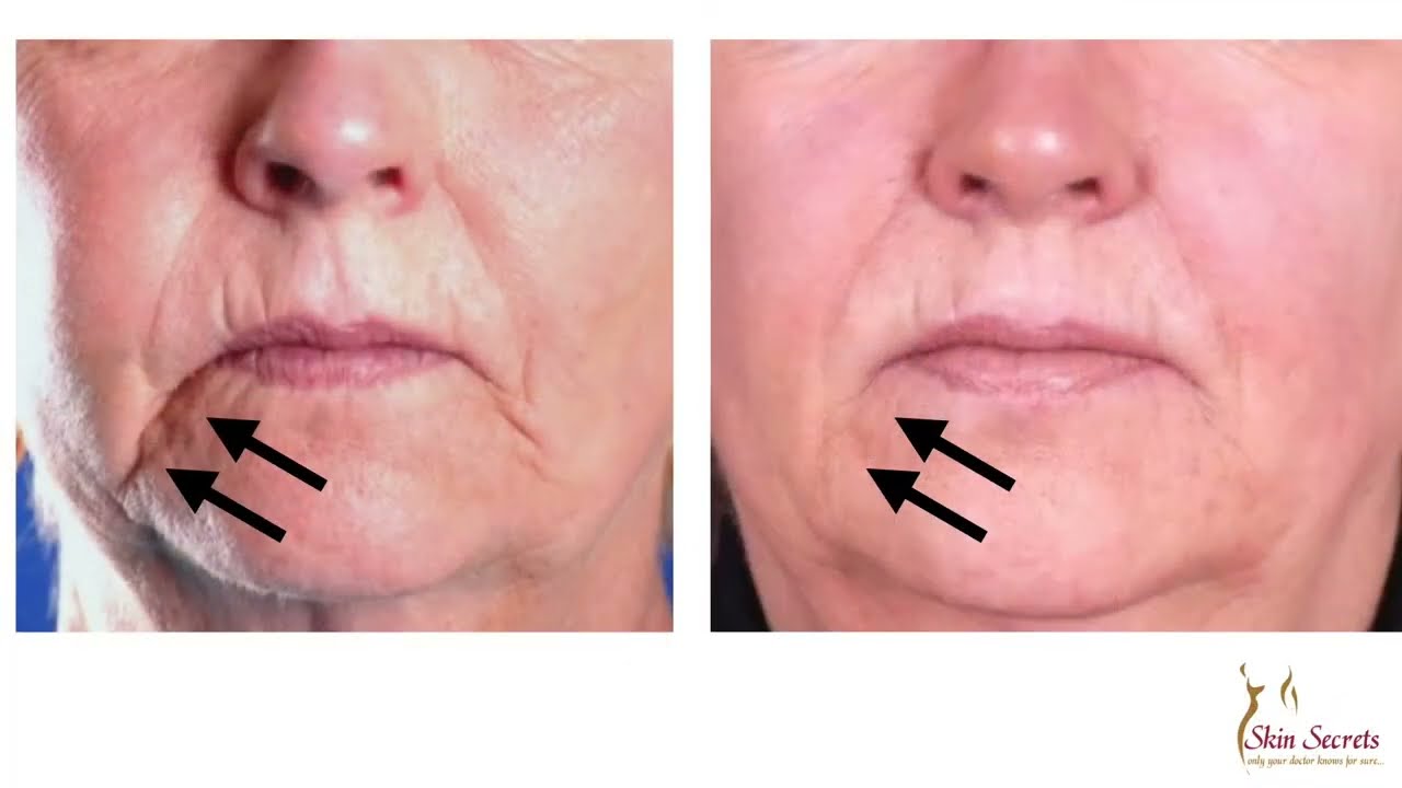 FILLER for Marionette Lines | Instant Results | Skin Secrets by Dr. McLaren