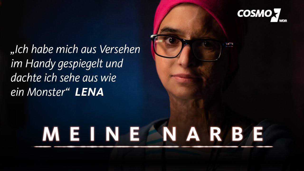 Lena wurde vom Blitz getroffen – die Verbrennungen haben Narben hinterlassen | Meine Narbe | COSMO