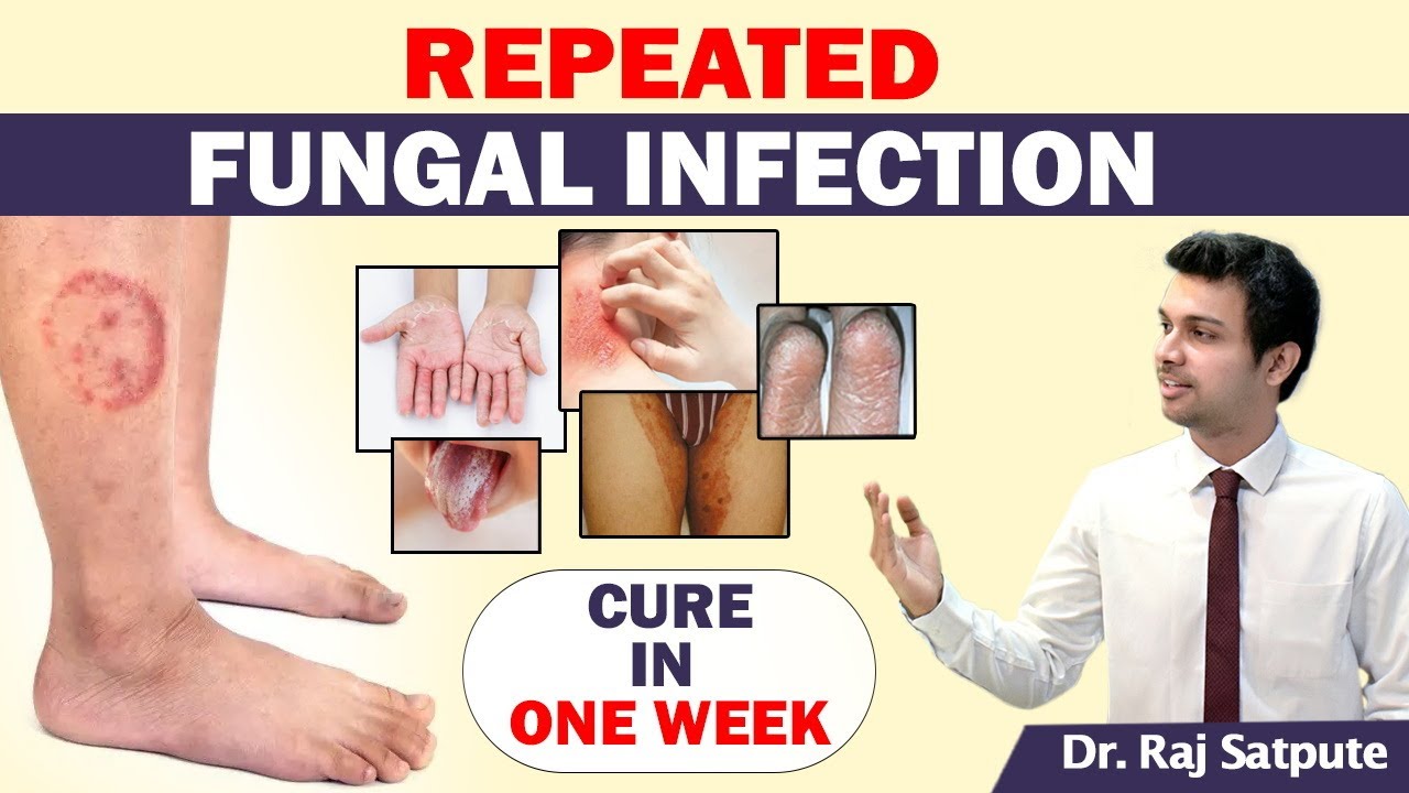 2 Reasons - Why Ayurveda Cures Fungal Infection | How to Get Rid of Any Skin Infection | JYOVIS