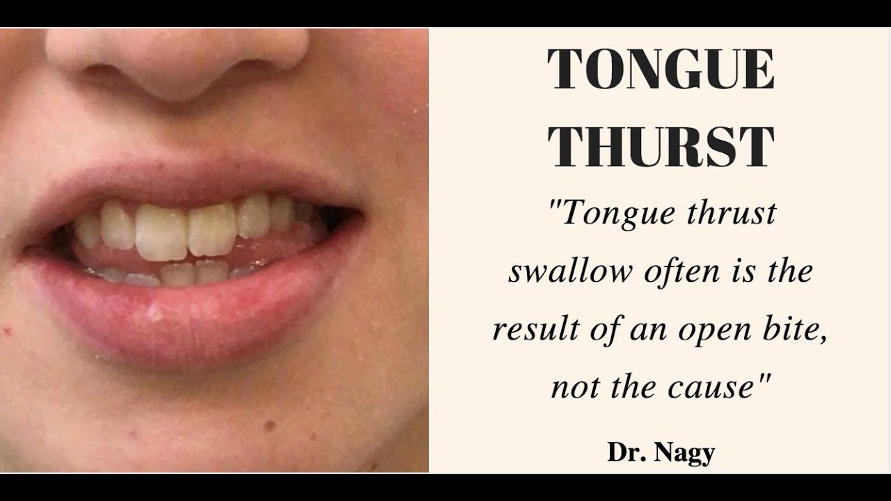 Tongue thrust swallow - Orthodontic Matters Episode 11