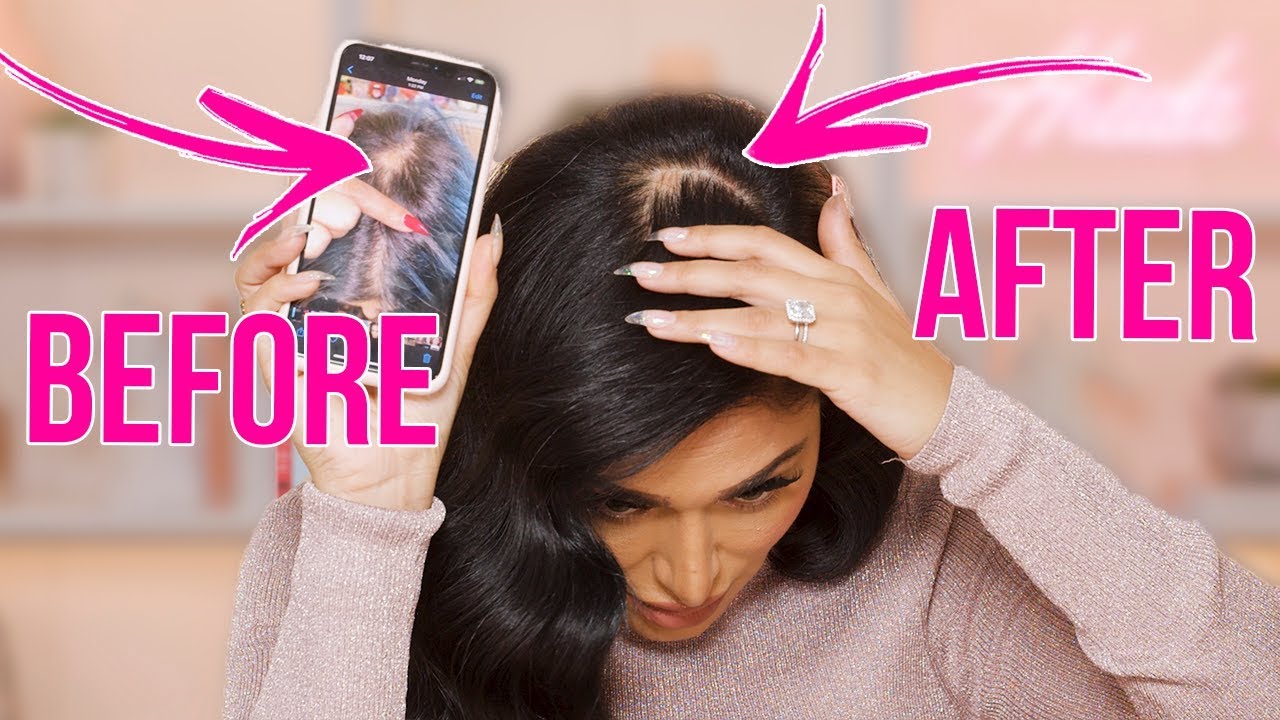 How to Get Rid Of Bald Spots - I tried it on myself!!! | البقعة الصلعاء: سببها وكيف عالجتها