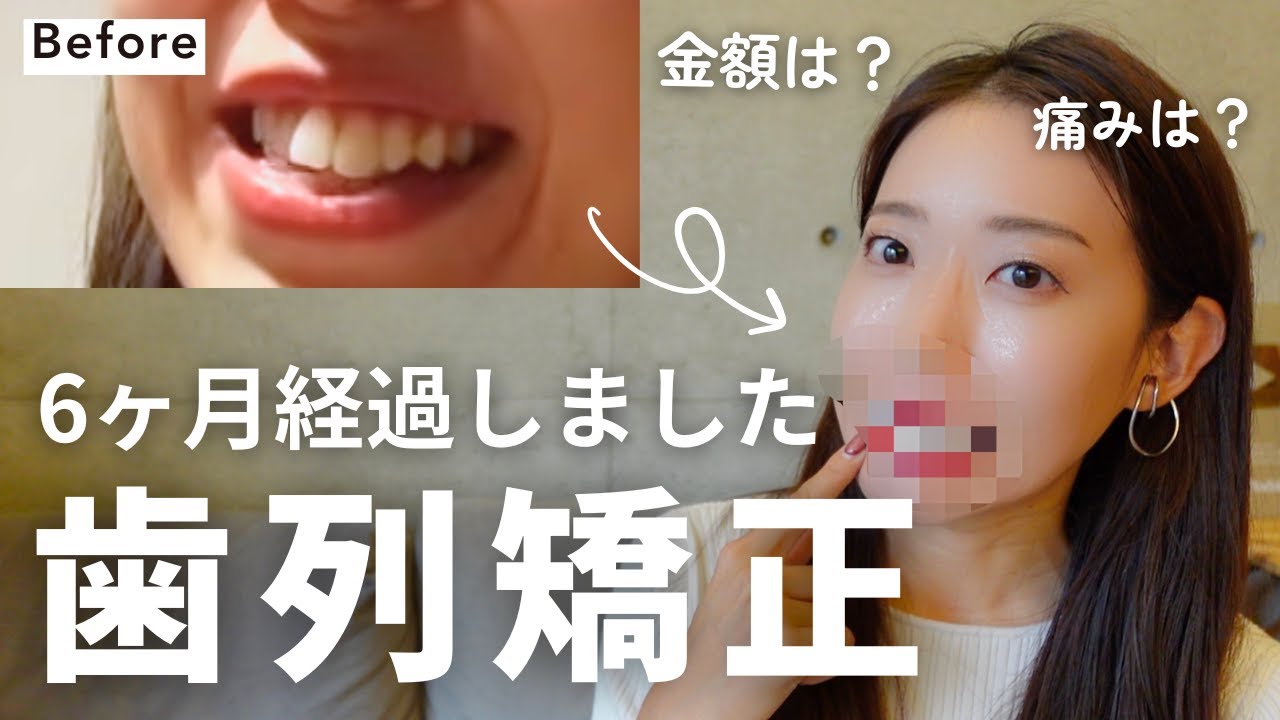 【歯列矯正】マウスピース矯正半年経過で顔が変わった!?🦷値段,メリット,デメリット,インビザライン,抜歯あり