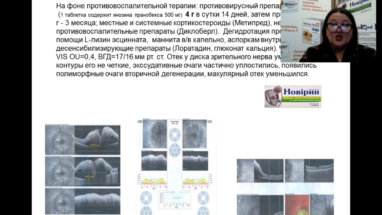 Синдром Фогта - Каянаги - Харада. Случай из практики - Коновалова Н.В.