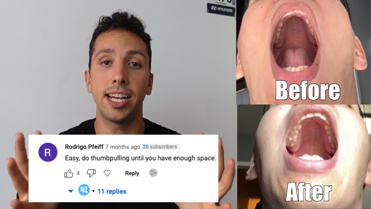 Can Thumb Pulling Really Work? (Mewing with a Narrow Palate Part 2)