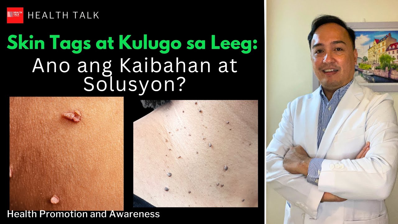 Skin Tags at Kulugo sa Leeg: Ano ang Kaibahan at Solusyon?