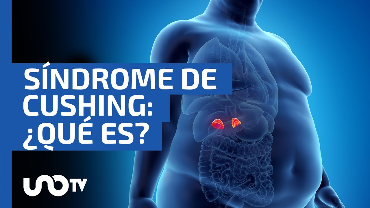 S&iacute;ndrome de Cushing: &iquest;qu&eacute; es este raro padecimiento y cu&aacute;les son sus s&iacute;ntomas?