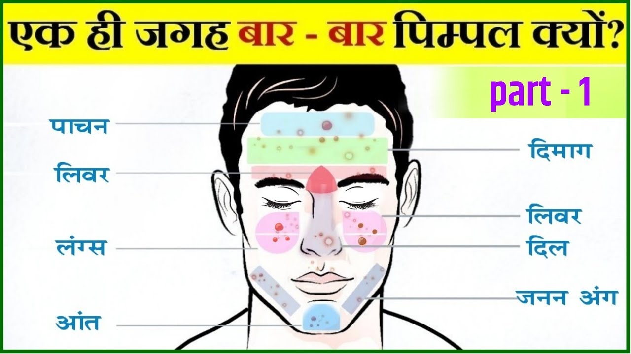 पिम्पल कील मुहासे हमेशा के लिए ख़त्म करने का असरदार तरीका | Acne pimples permanent solution (part-1)