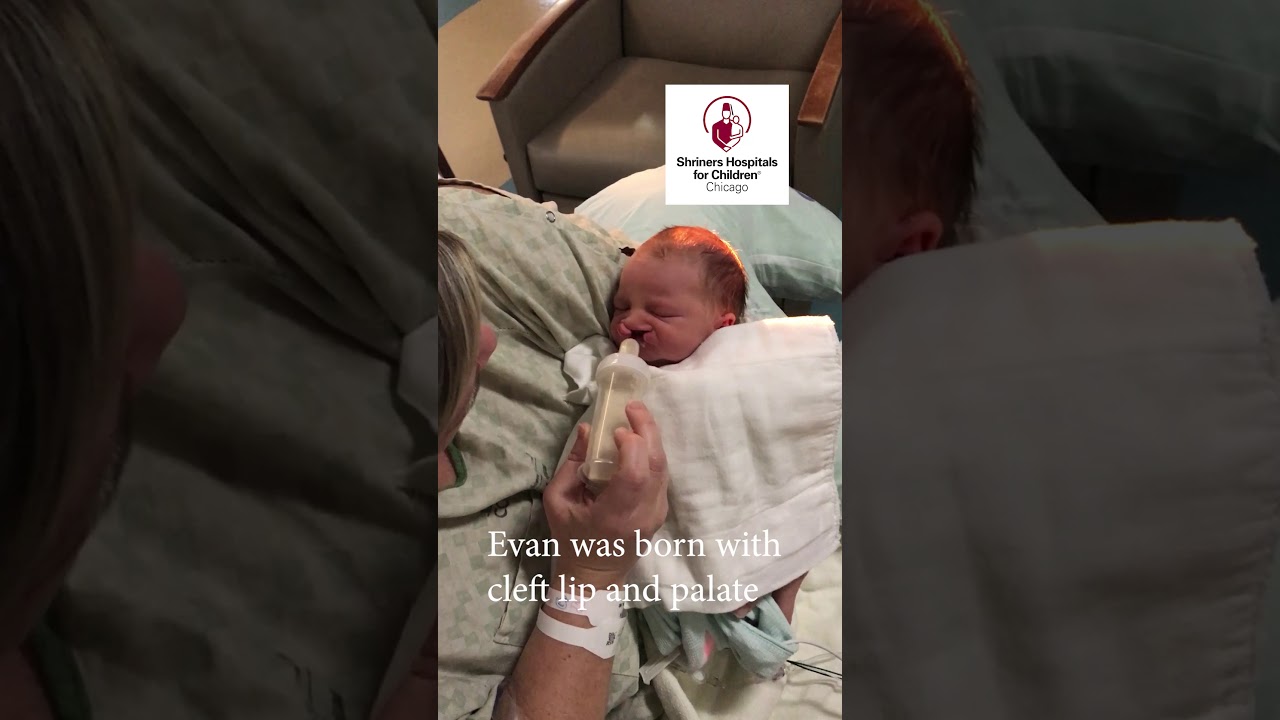 Evan - First Feeding | Cleft Palate journey
