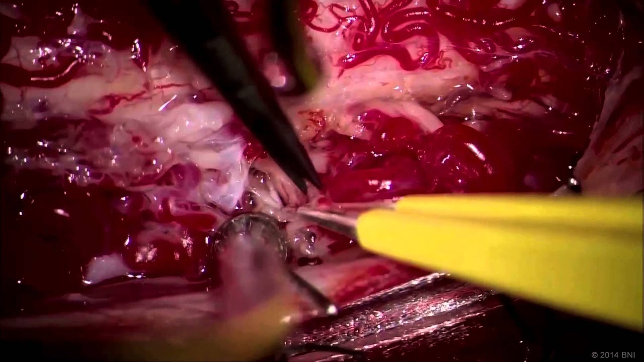 Microsurgical resection of cervical spinal AVM: the pial resection technique