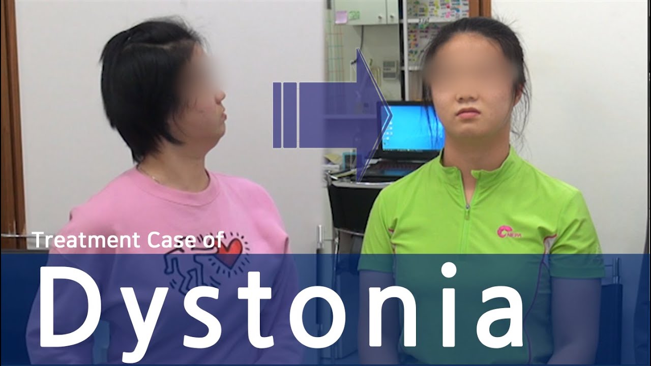 Dystonia / Cervical Dystonia / Spasmodic Torticollis / 사경증 치료 / 근긴장이상증