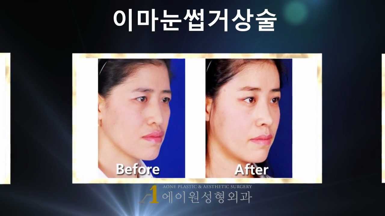 (Korea) Aone Plastic Surgery before & after [ endoforehead-brow lift ]