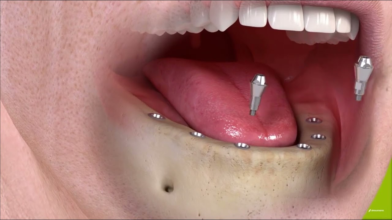 réhabilitation mandibulaire sur 6 implants avec mise en chrage immédiate d'un bridge, All on six