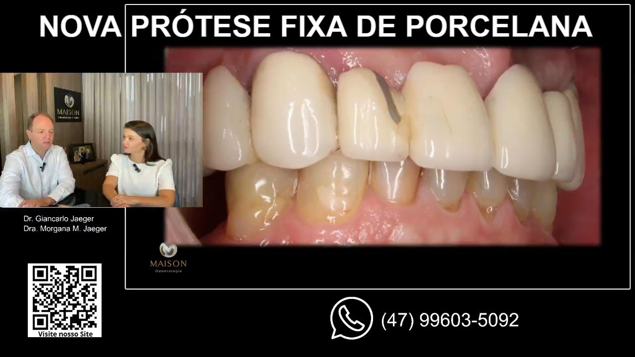 Protese fixa de Porcelana Livre de Metal (metalfree)