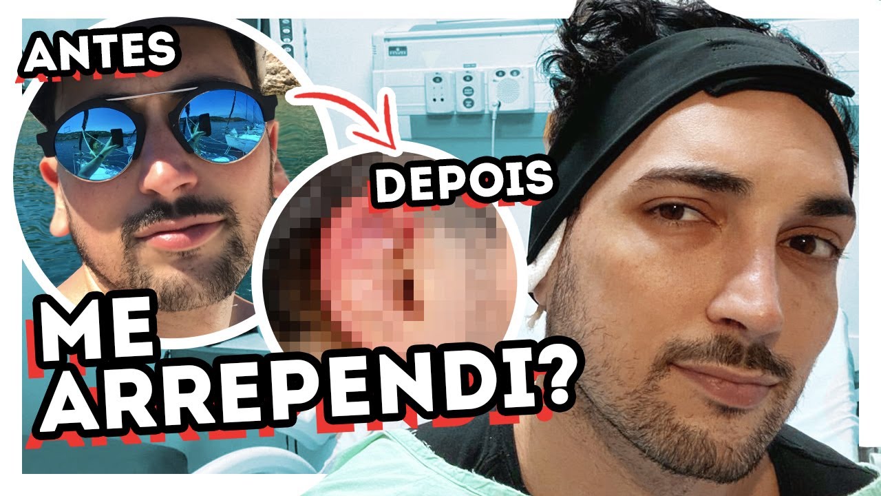 ANTES e DEPOIS da MINHA CIRURGIA de OTOPLASTIA - PREÇOS, PERGUNTAS e VLOG COMPLETO da RECUPERAÇÃO