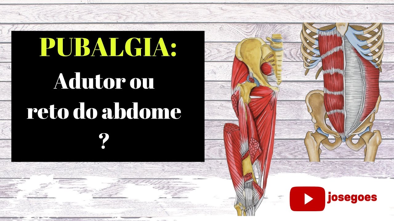 Pubalgia: adutores ou reto do abdome ?
