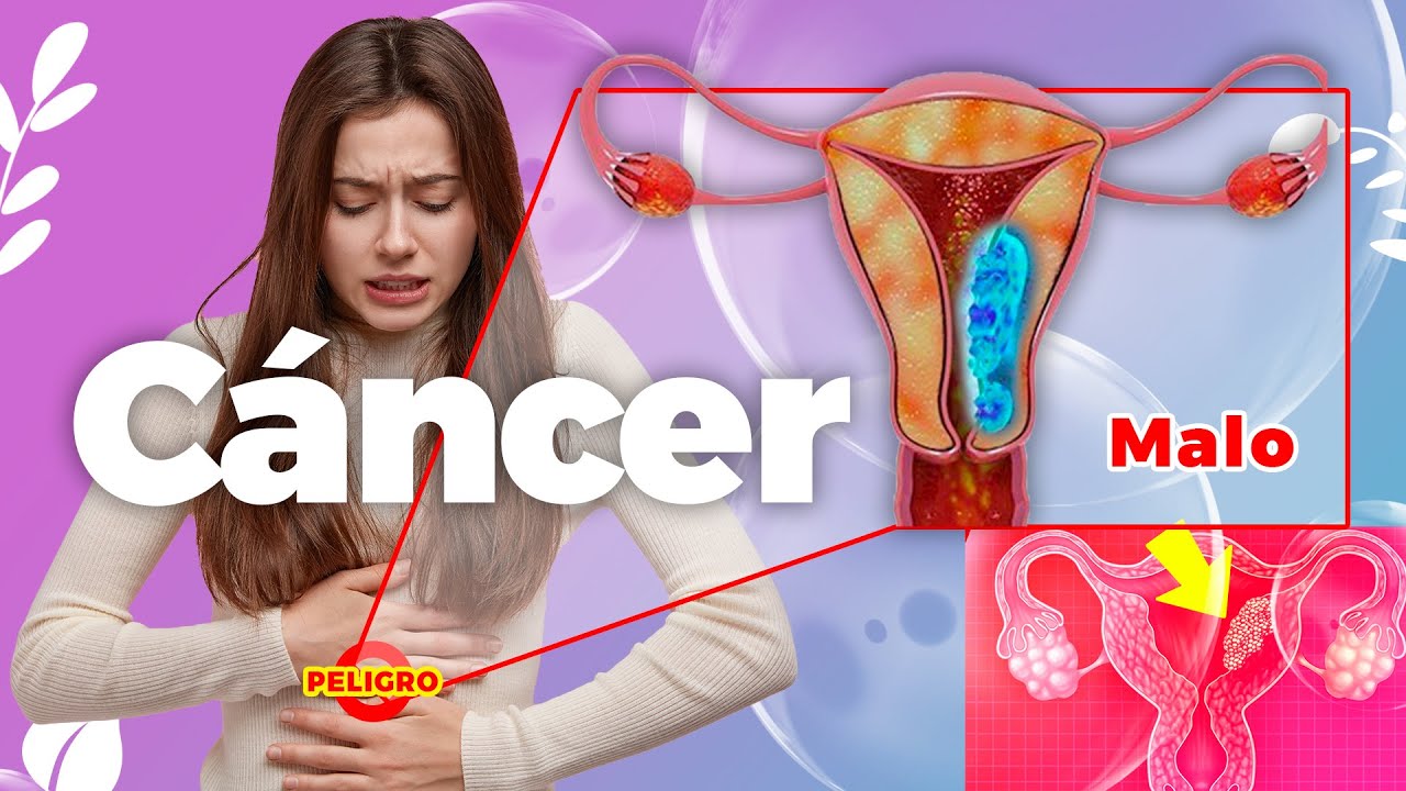 ¡Qué hacer si te diagnosticaron cáncer de endometrio!