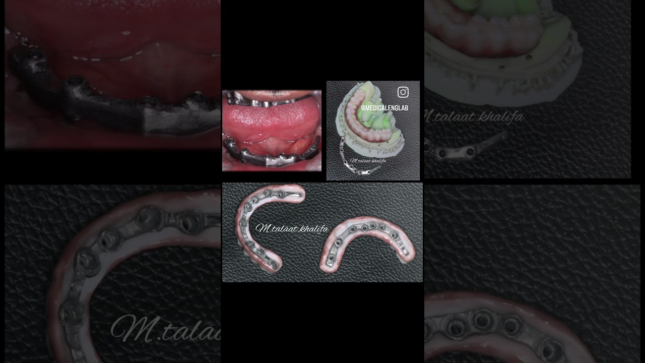 #dentist #zirconia #implant #emax #lab #fullanatomy