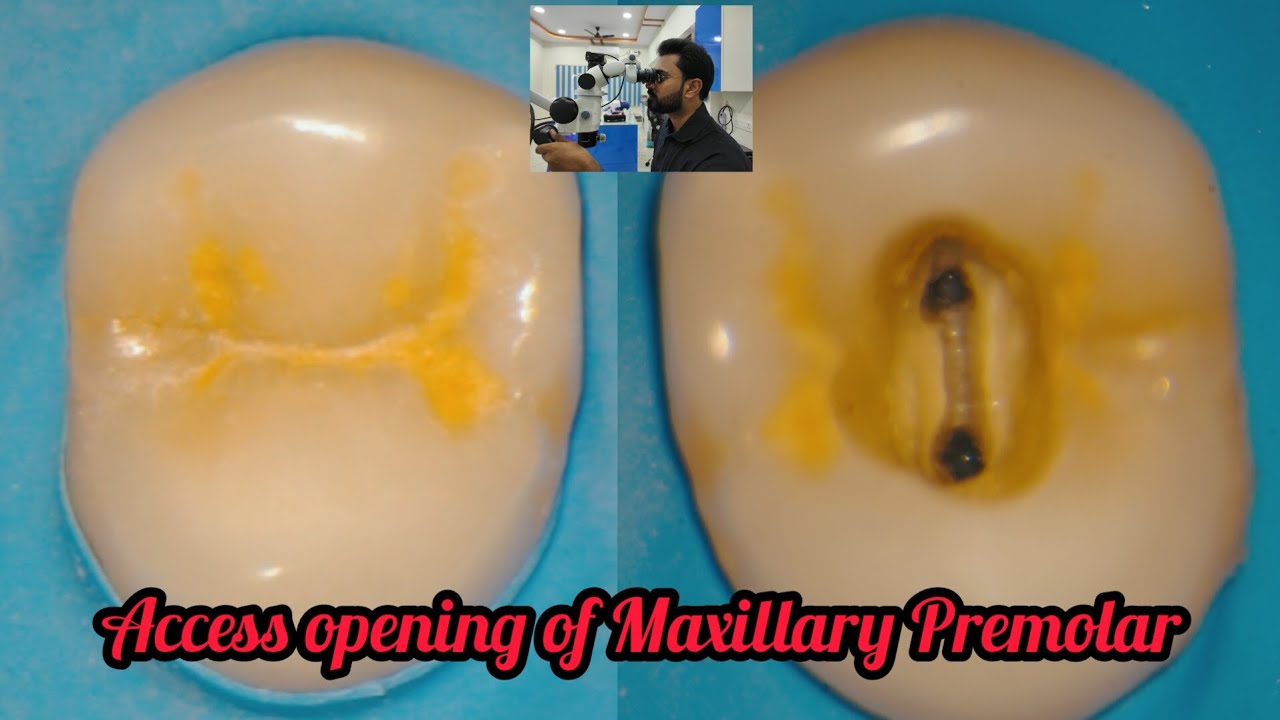 Access opening of Maxillary Premolar# step by step root canal demonstration#rct for beginners