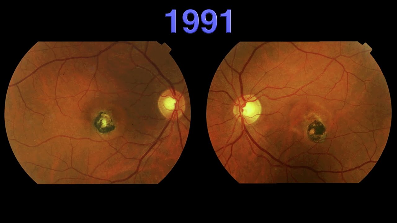 Distrofia foveomacular viteliforme del adulto