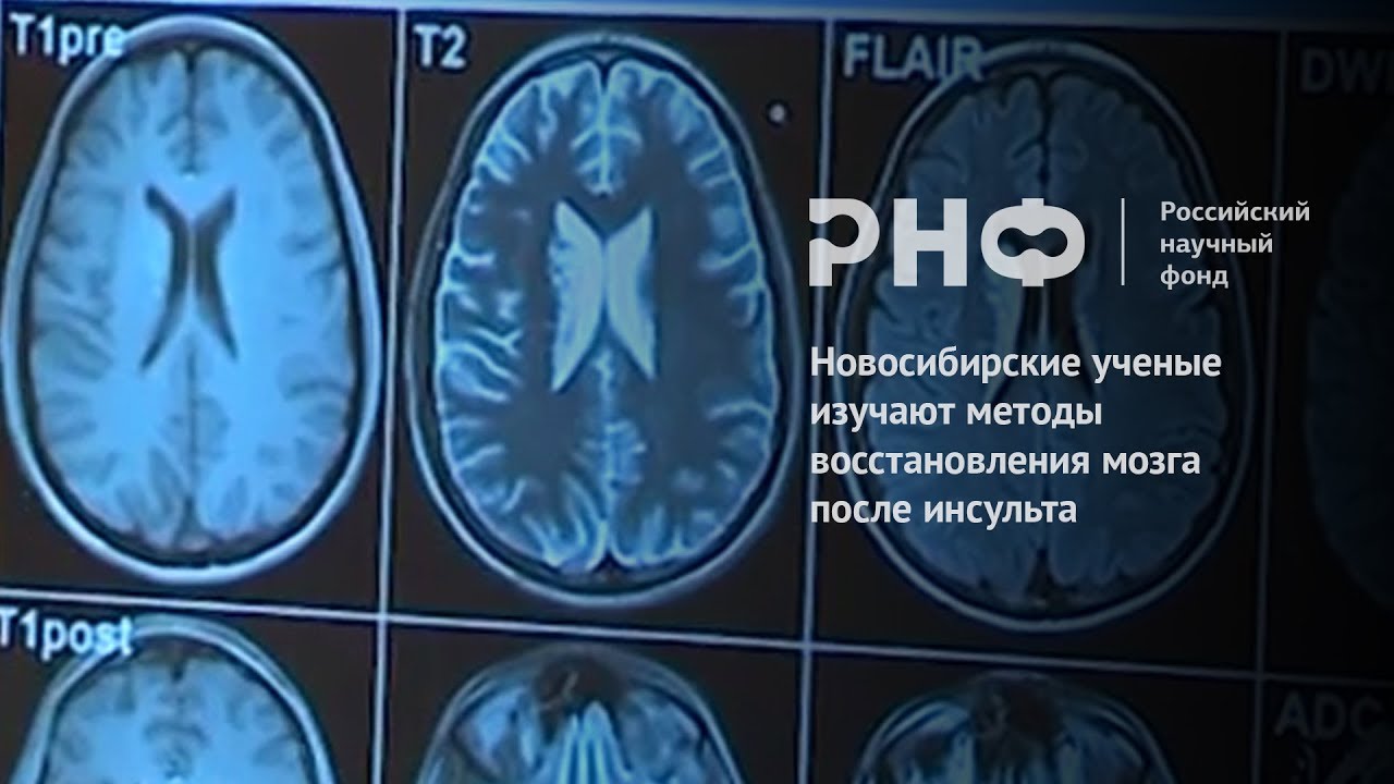 Новосибирские ученые изучают методы восстановления мозга после инсульта