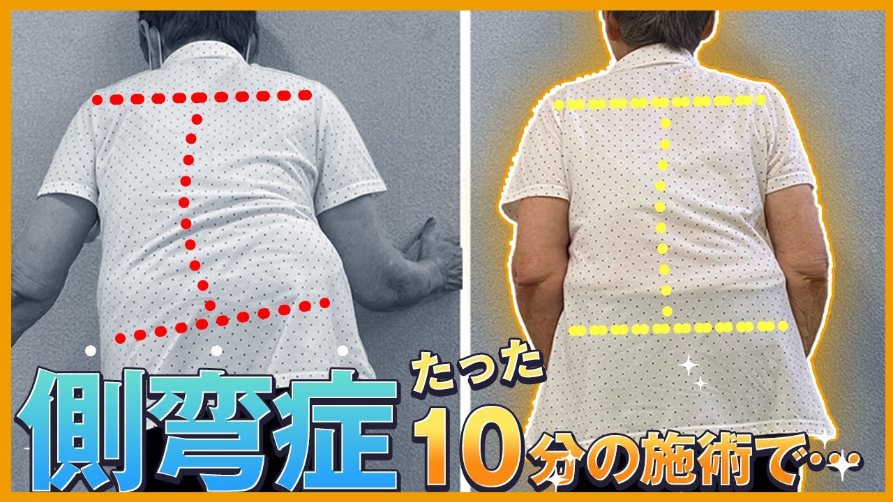 【側弯症】たった１０分のソフトタッチ施術で…｜ゴッドハンド通信｜中井マサル