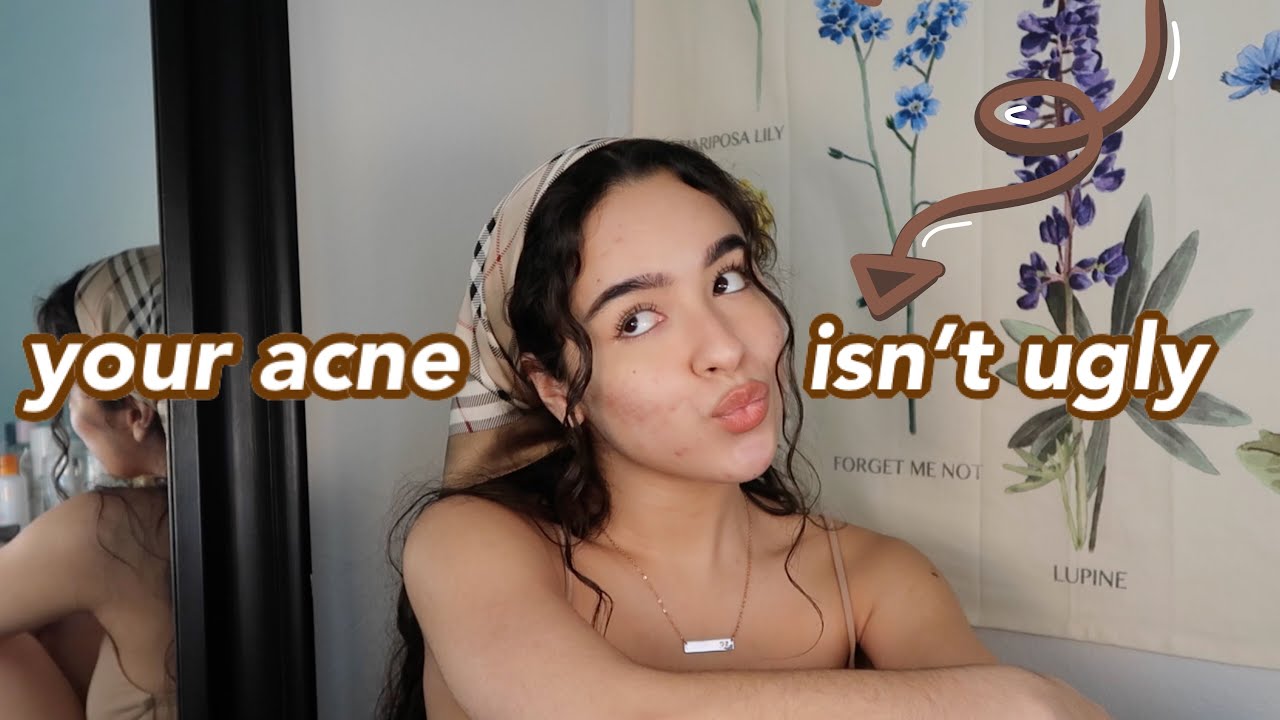 why having acne DOESN'T make you ugly, let's talk + q&a [self-love series]