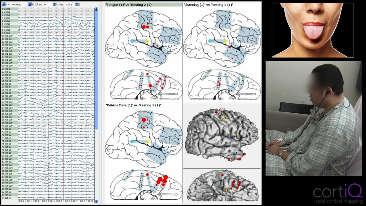 cortiQ Rapid Brain Mapping: Temporal Dynamics of the Brain