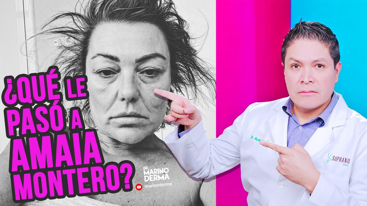 ¿QUE LE PASÓ A AMAIA MONTERO de la Oreja de Van Gogh?.  Dermatologo analiza su piel.