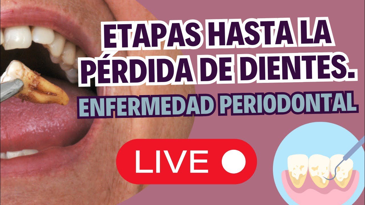 EN DIRECTO: Cómo es el proceso de una enfermedad periodontal 🧐🦷