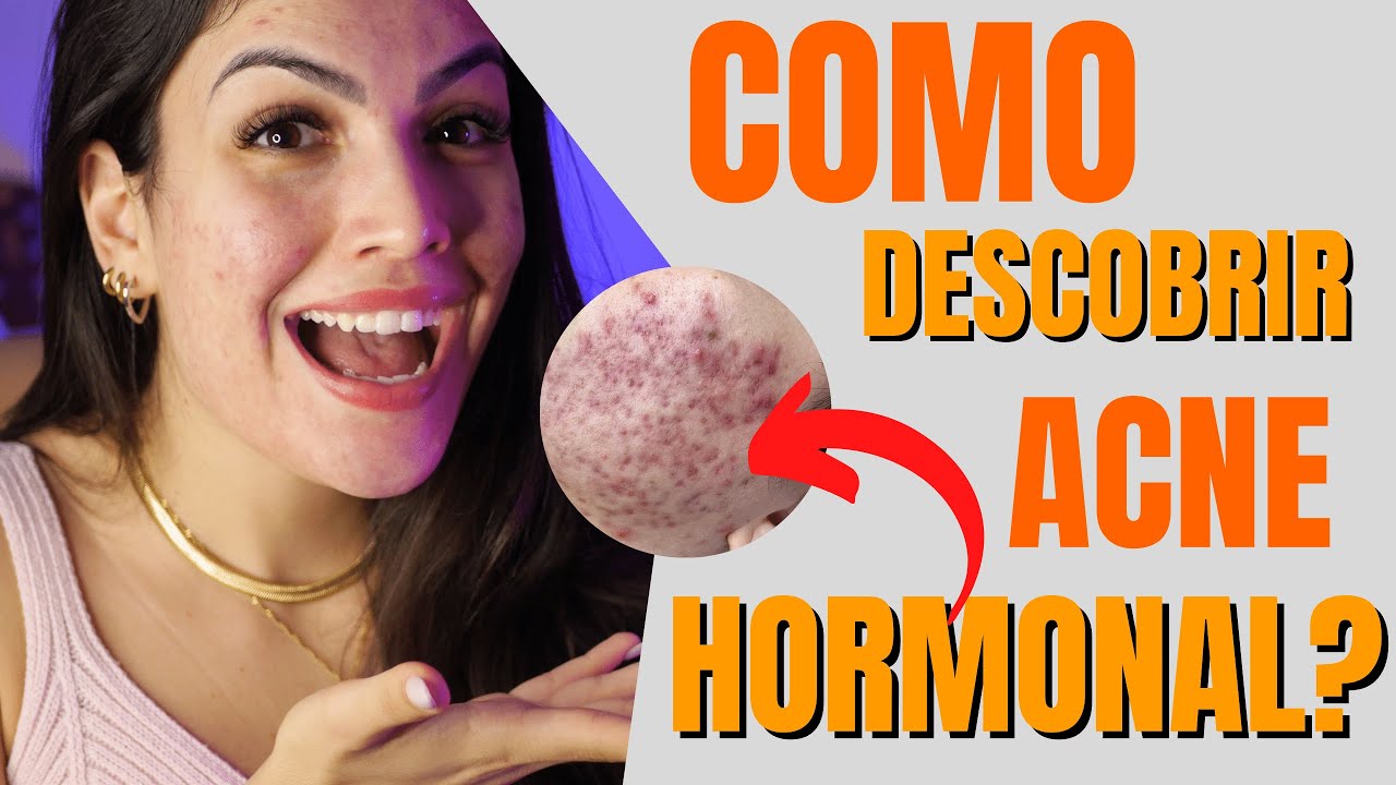 ACNE HORMONAL: 7 SINAIS para você identificar