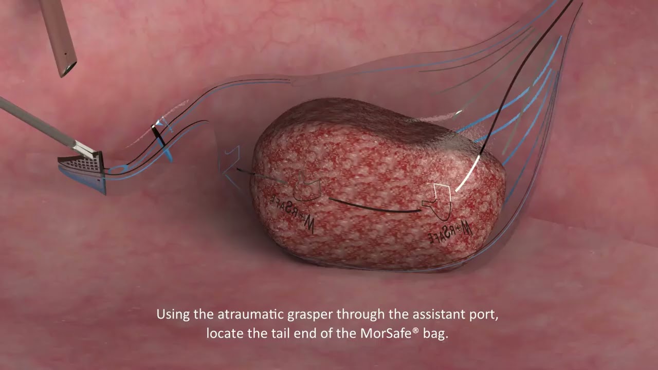 Versator Tissue Morcellation System & MorSafe Bag - In Bag Morcellation Training Video