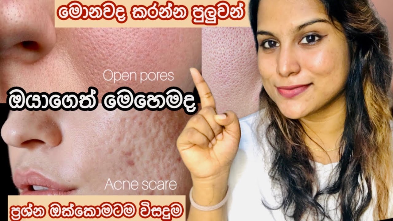 Acne scars , open pores වලට ස්තීර විසදුම | මොනවද කරන්න ඔනේ | #skincare #vlog #skincareroutine