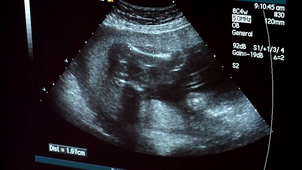 usg dzidka, chlopczyk czy dziewczynka