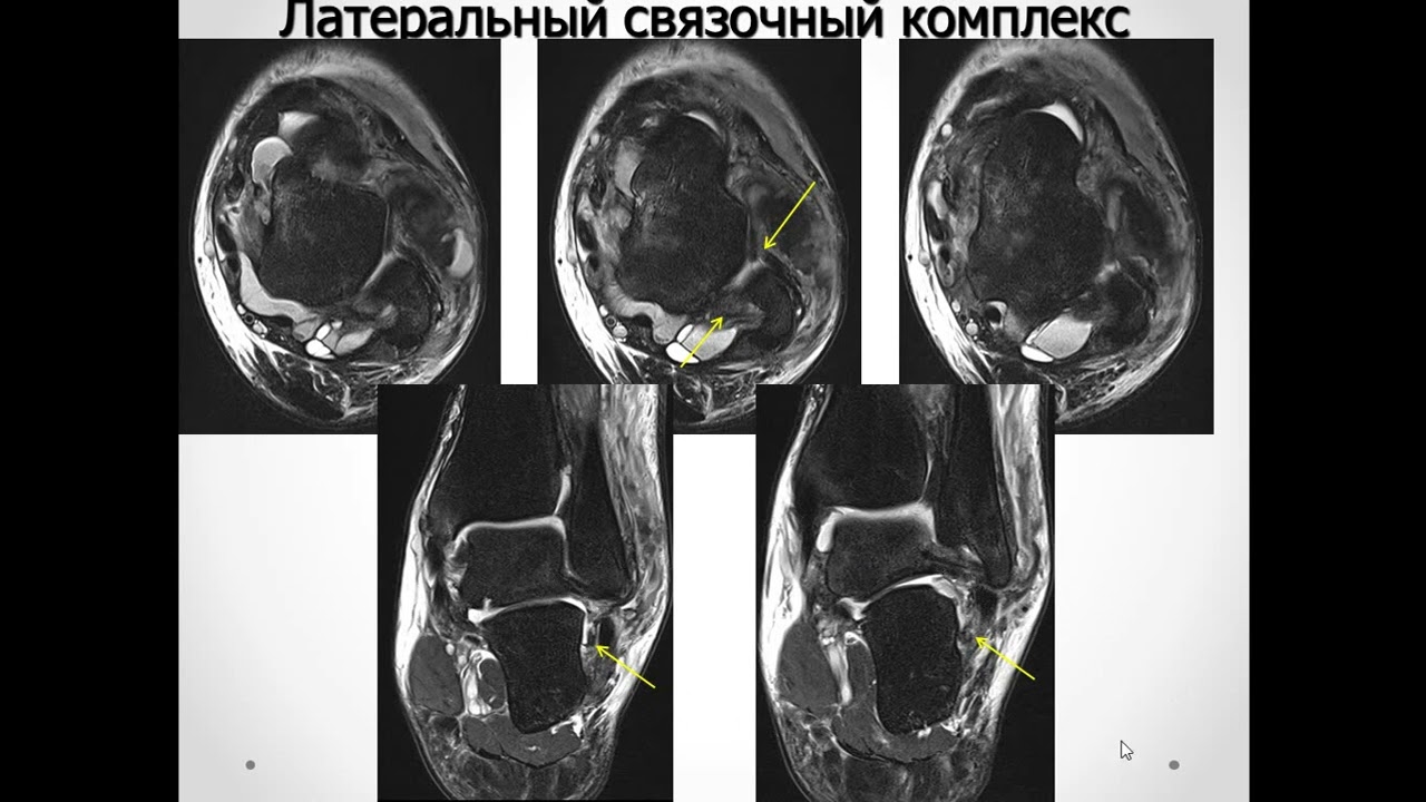 Базовый курс по МРТ  b  Лекция «МР семиотика повреждений голеностопного сустава»  Лектор  Учеваткин