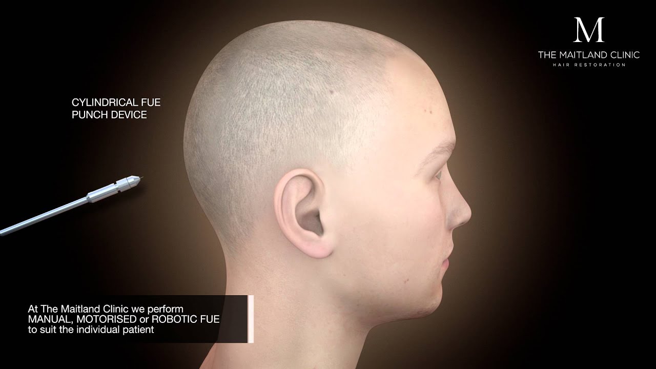 FUE Animation- The Maitland Clinic