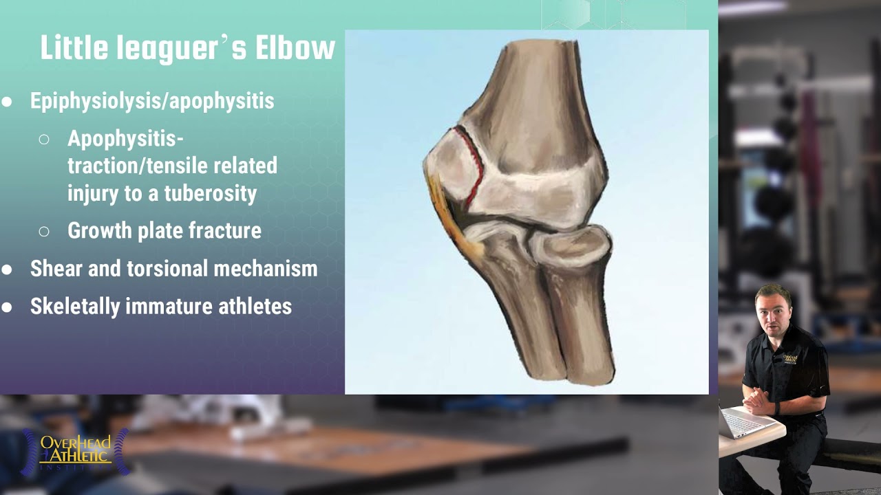 Injuries in Youth Baseball: Little Leaguer’s Elbow, Little Leaguer’s Shoulder, and Panner’s Disease