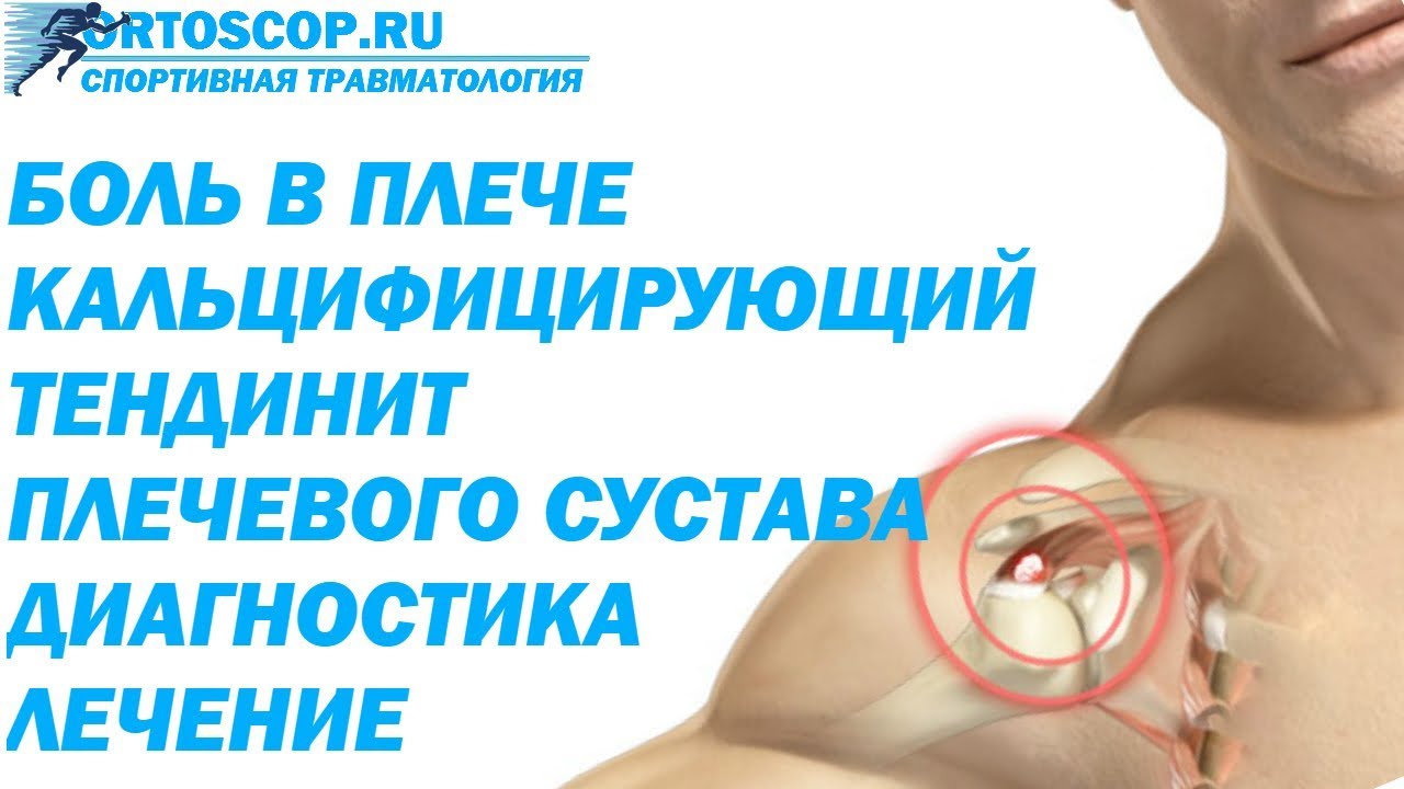 КАЛЬЦИФИЦИРУЮЩИЙ ТЕНДИНИТ ПЛЕЧЕВОГО СУСТАВА
