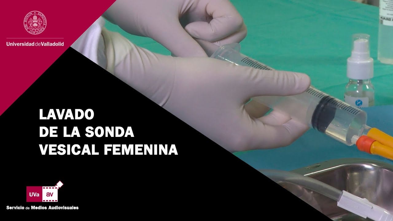 LAVADO DE LA SONDA VESICAL FEMENINA