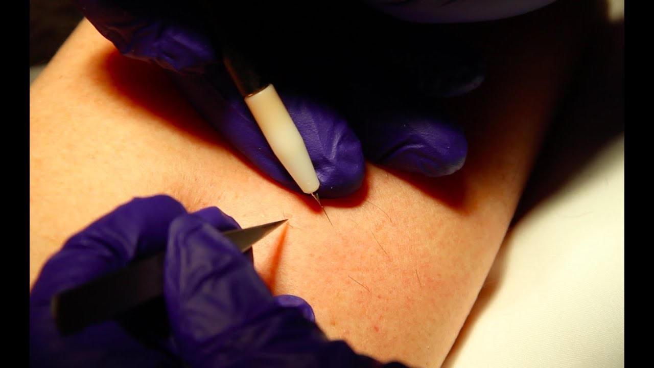 Electrolysis Hair Removal with Dana Elise