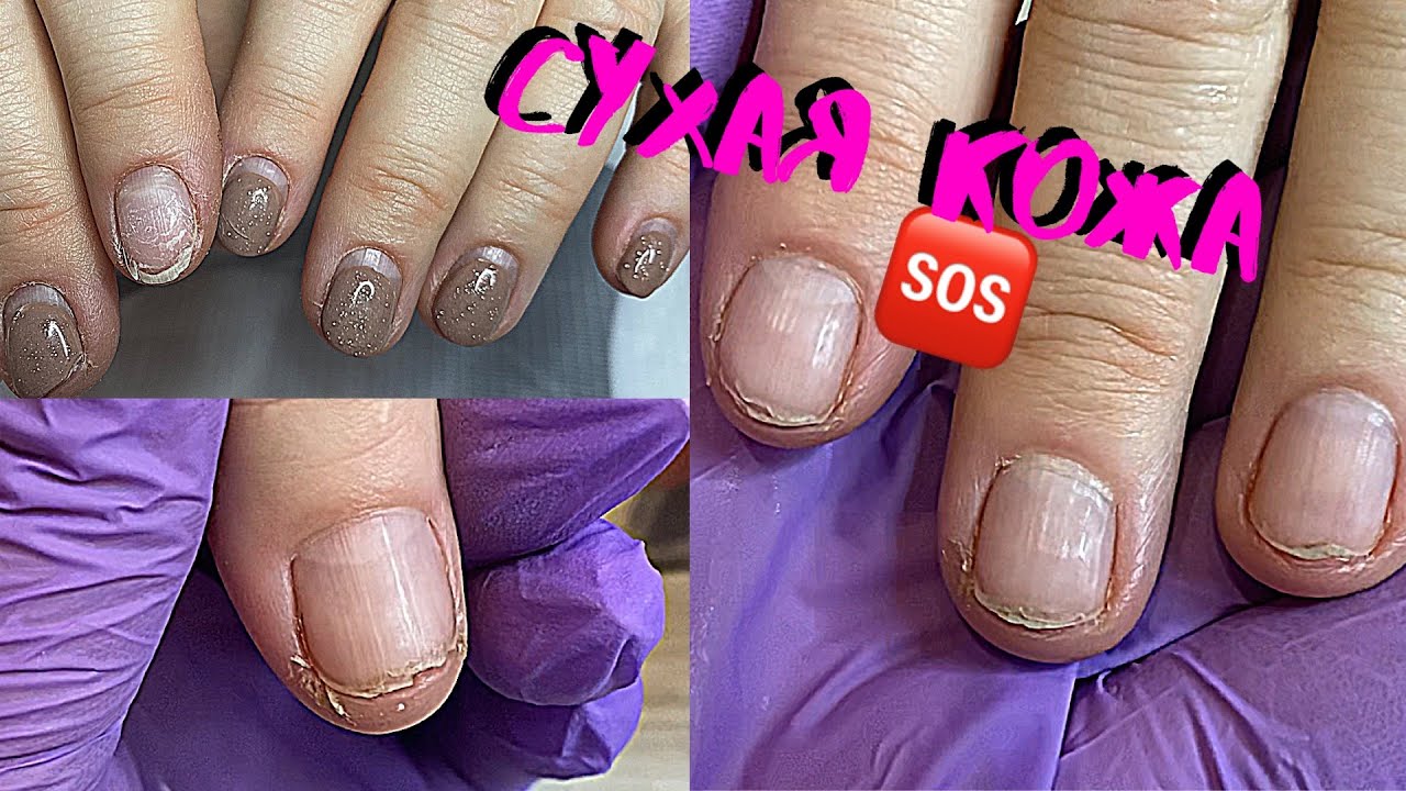 😱ЖУТКО СУХАЯ КОЖА❗️ДЕЛАЕМ КОРРЕКЦИЮ| |ТРЕЩИНЫ НА ПАЛЬЦАХ РУК В КРОВЬ, КАК БЕЗОПАСНО ВСЕ УБРАТЬ ⁉️
